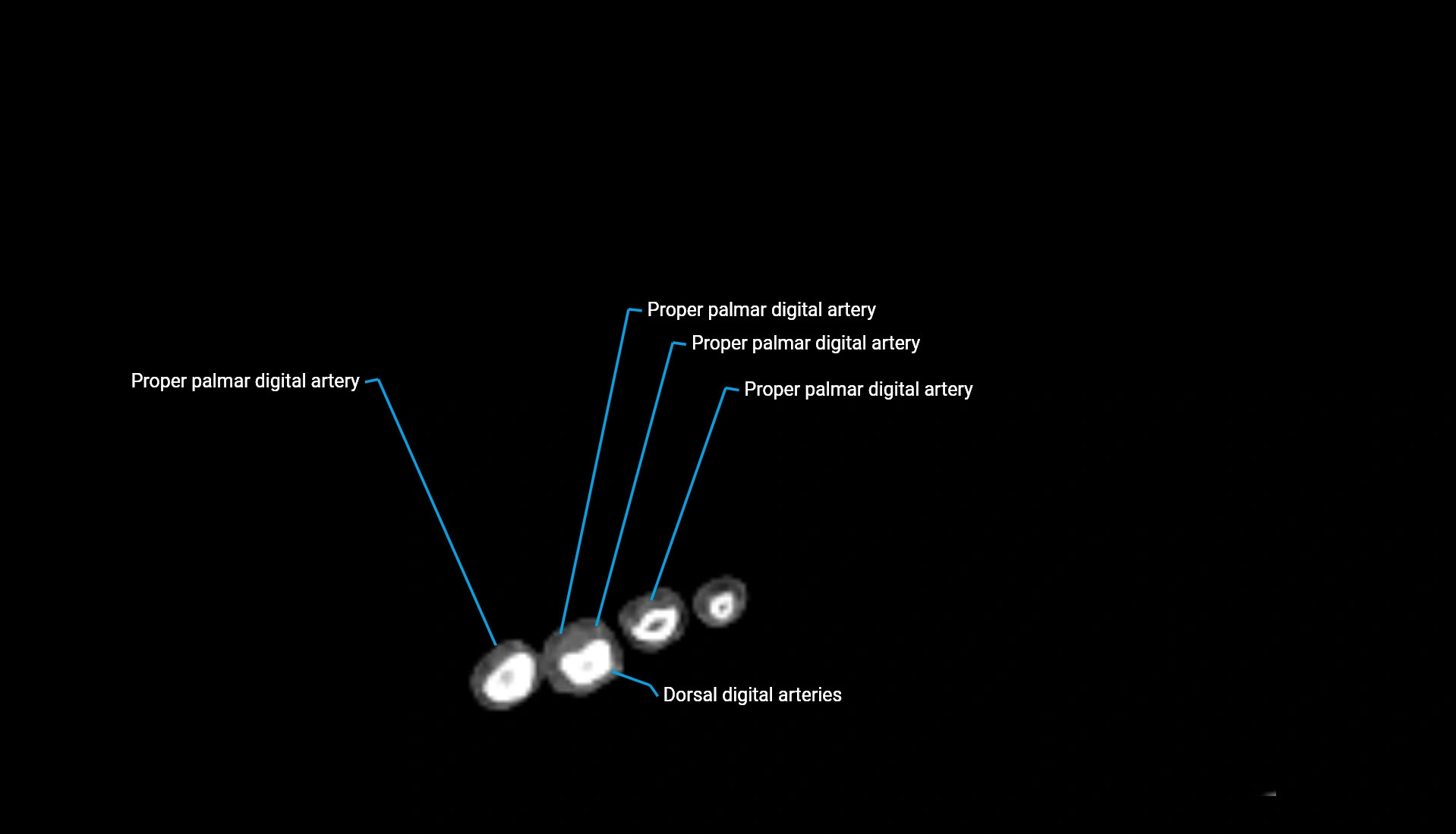 CTA upper limb axial cross sectional anatomy labelled image 24 (2).webp